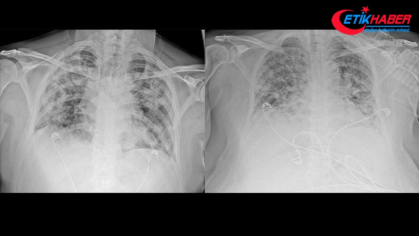 Kovid-19'un akciğerlere verdiği zarar tomografi görüntülerine yansıyor